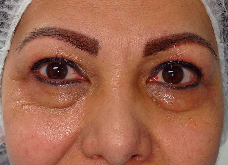 Blefaroplastia superior — antes
